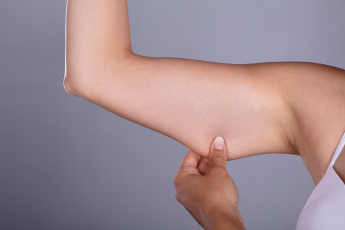 Femme qui se prend la graisse du bras pour faire un lifting de la face interne du bras