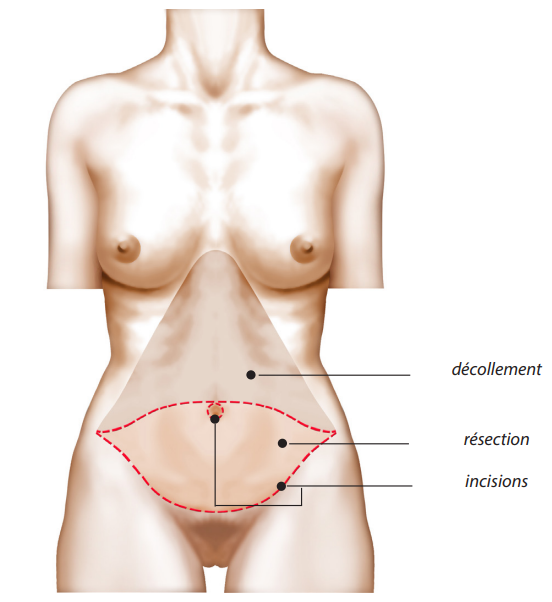 abdominoplastie