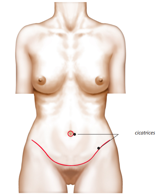 cicatrices abdominoplastie