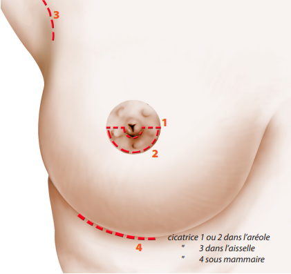 insertion prothèse mammaire