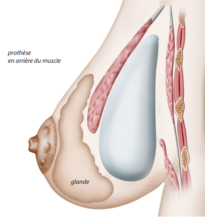 prothèse rétro musculaire