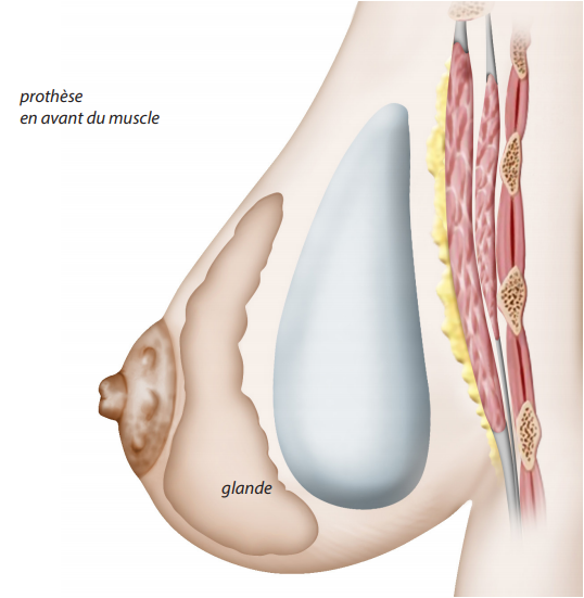 prothèse pré musculaire