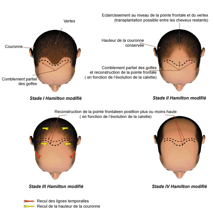 classification calvitie