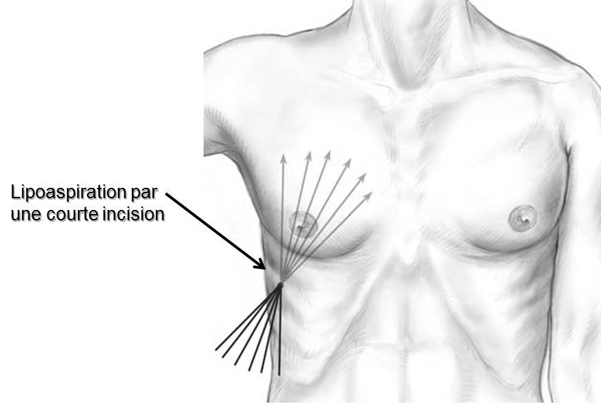 gynecomastie incisions