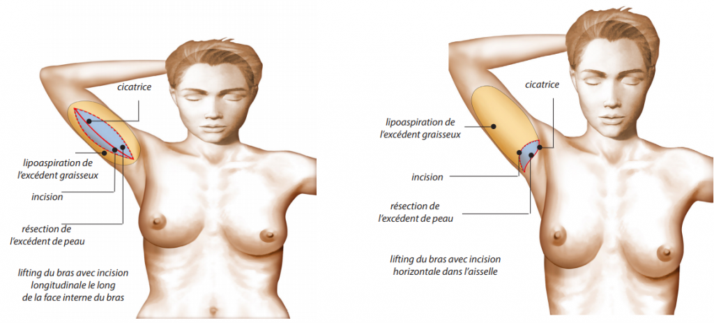 techniques lifting du bras