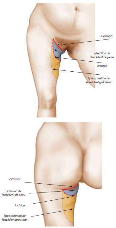 lifting cuisse excès cutané faible