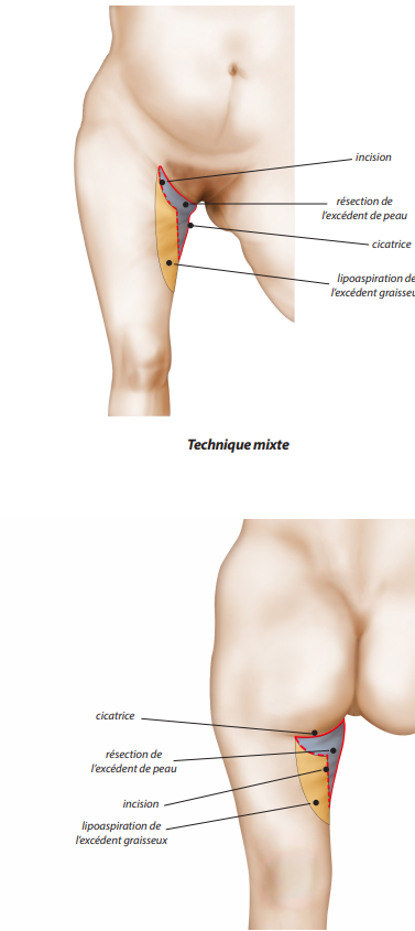 Lifting de la face interne de la cuisse - Dr Gilbert VITALE