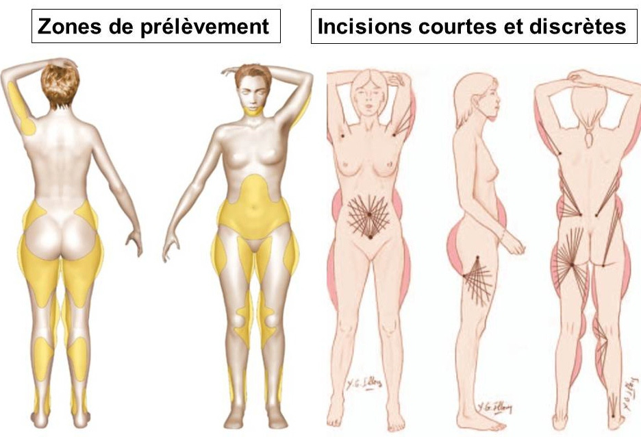 prélèvements de graisses lipostructure seins