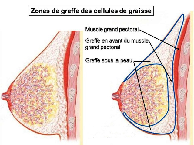 injection des graisses lipostructure seins