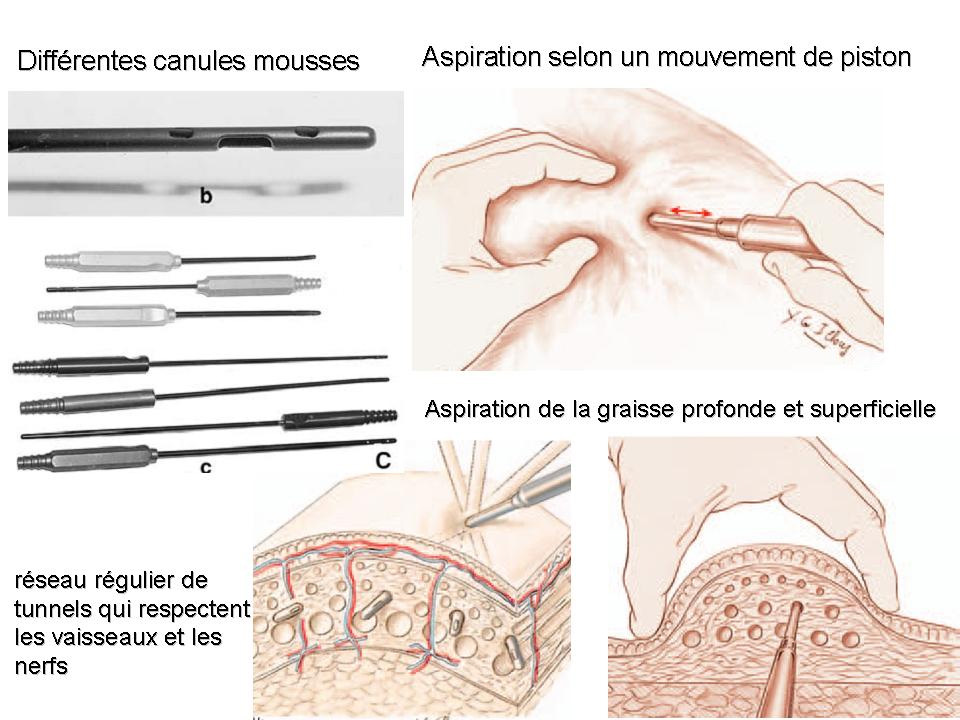 canules liposuccion