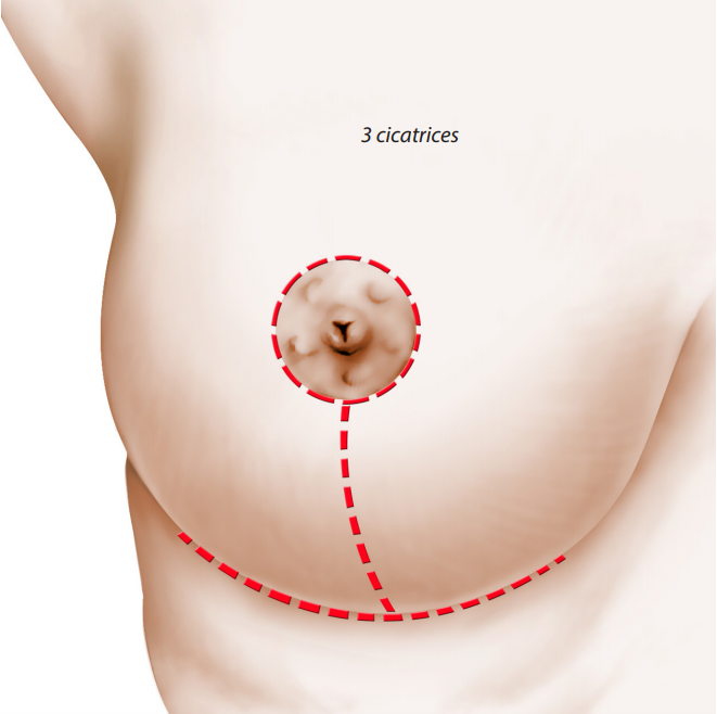 incisions en ancre de bateau