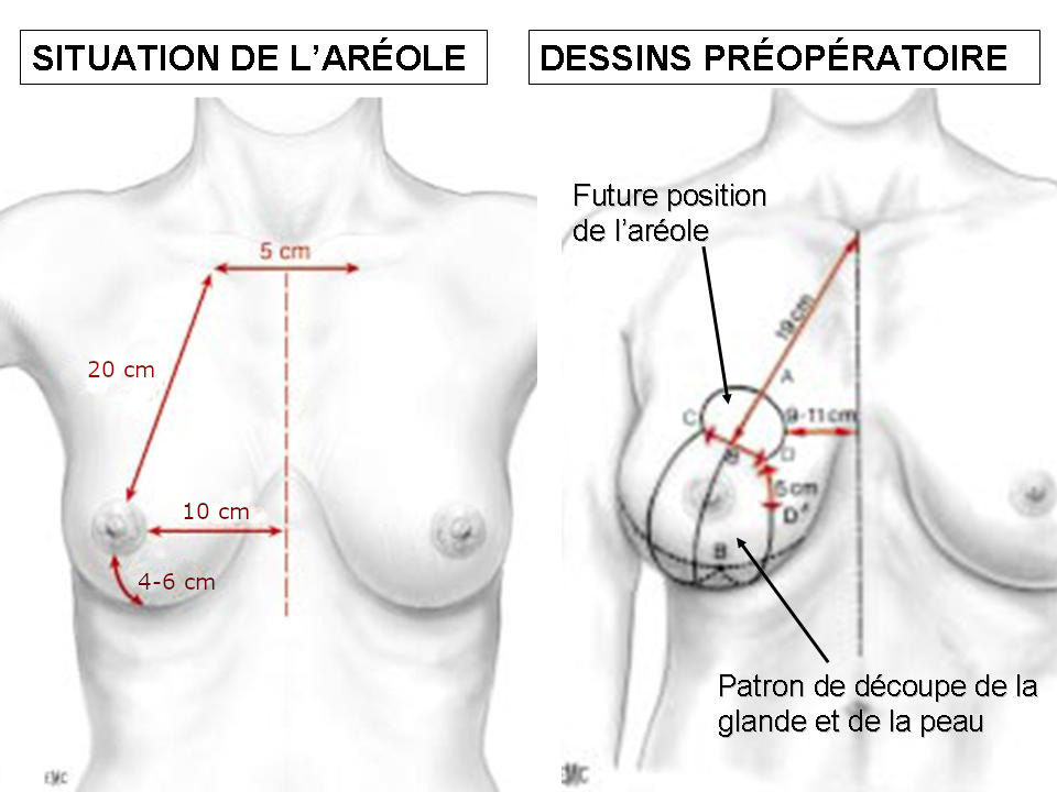 réduction mammaire