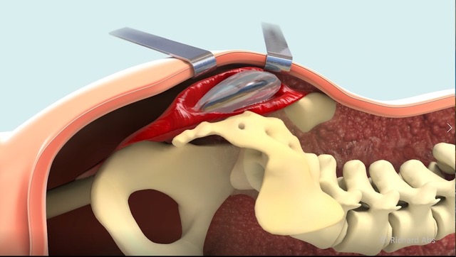 implant fessier