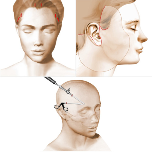 incisions lifting centro-facial