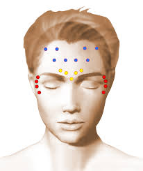 toxine botulique points d'injections